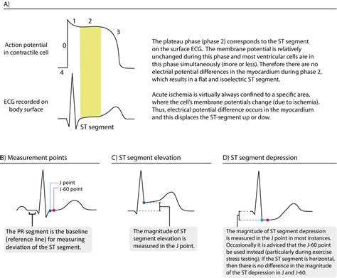 ECG in myocardial ischemia: ischemic changes in the .
